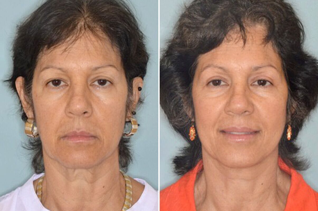 Brow Lift before and after, frontal.