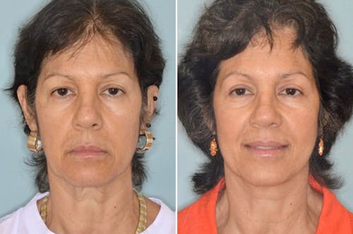 Brow Lift before and after, frontal.