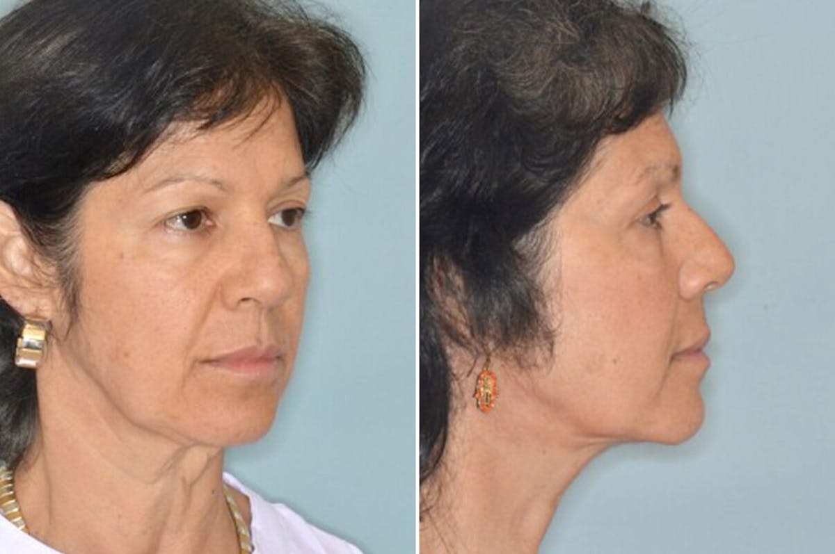 Brow Lift before and after, lateral right.