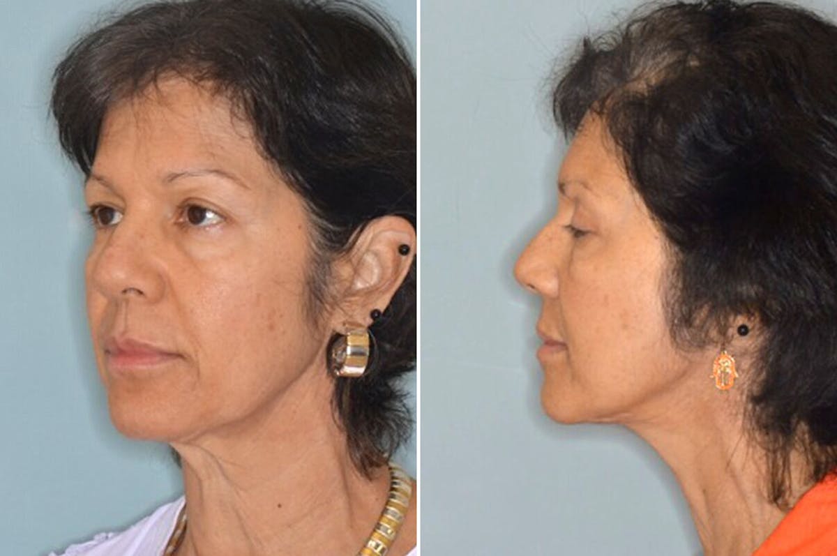 Brow Lift before and after, lateral left.