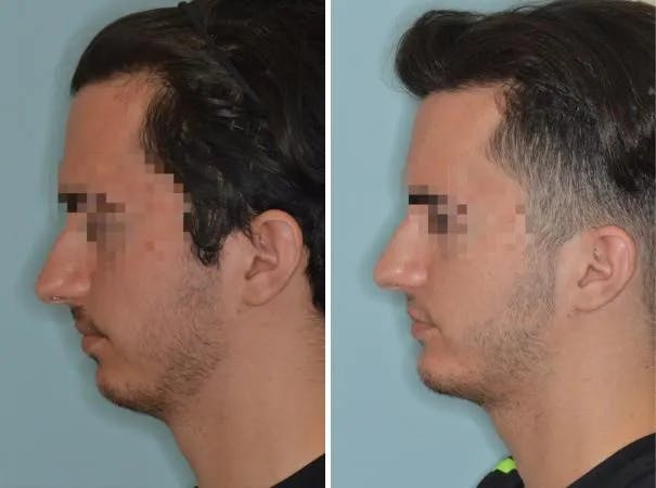 Chin Augmentation before and after, lateral left.