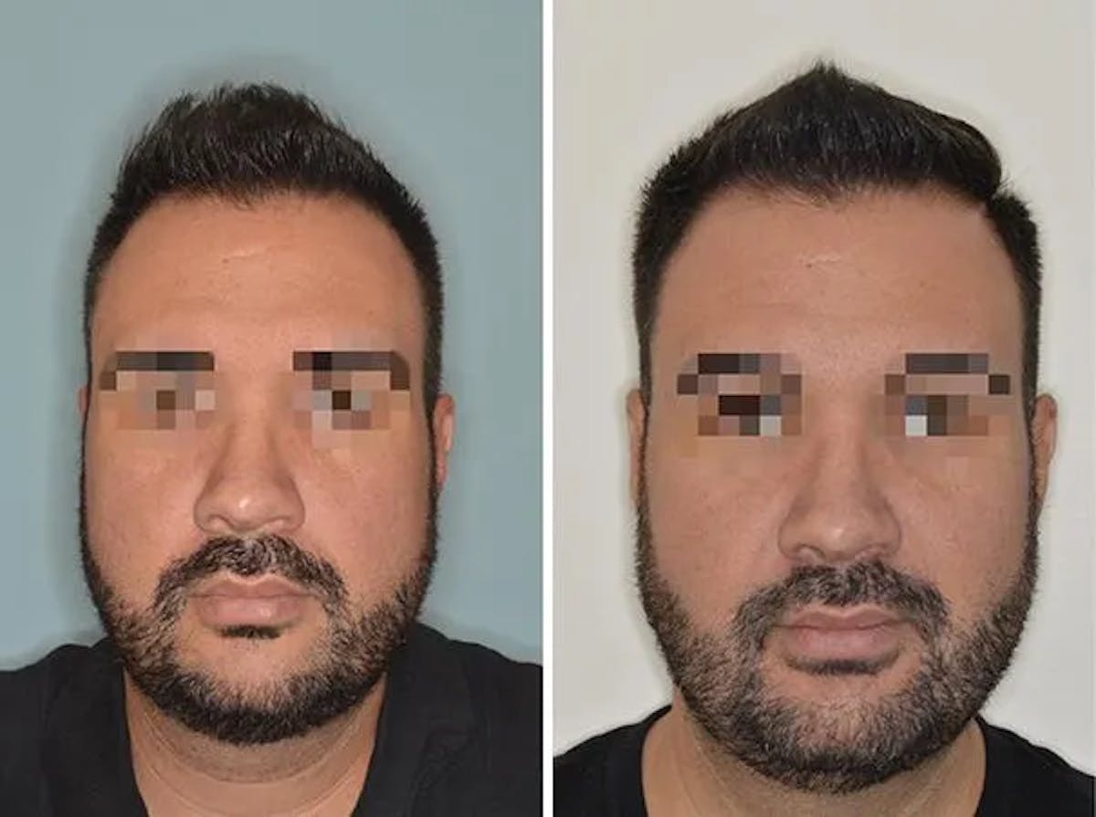 Chin Augmentation before and after, frontal.
