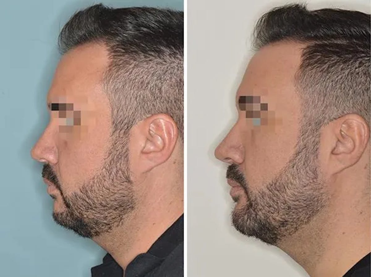 Chin Augmentation before and after, lateral left.