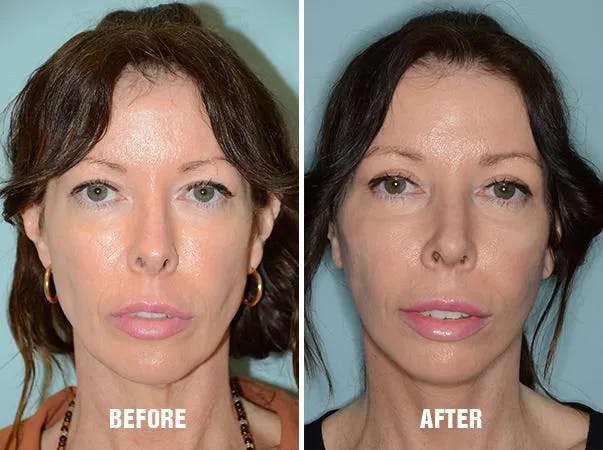 Chin Augmentation before and after, frontal.