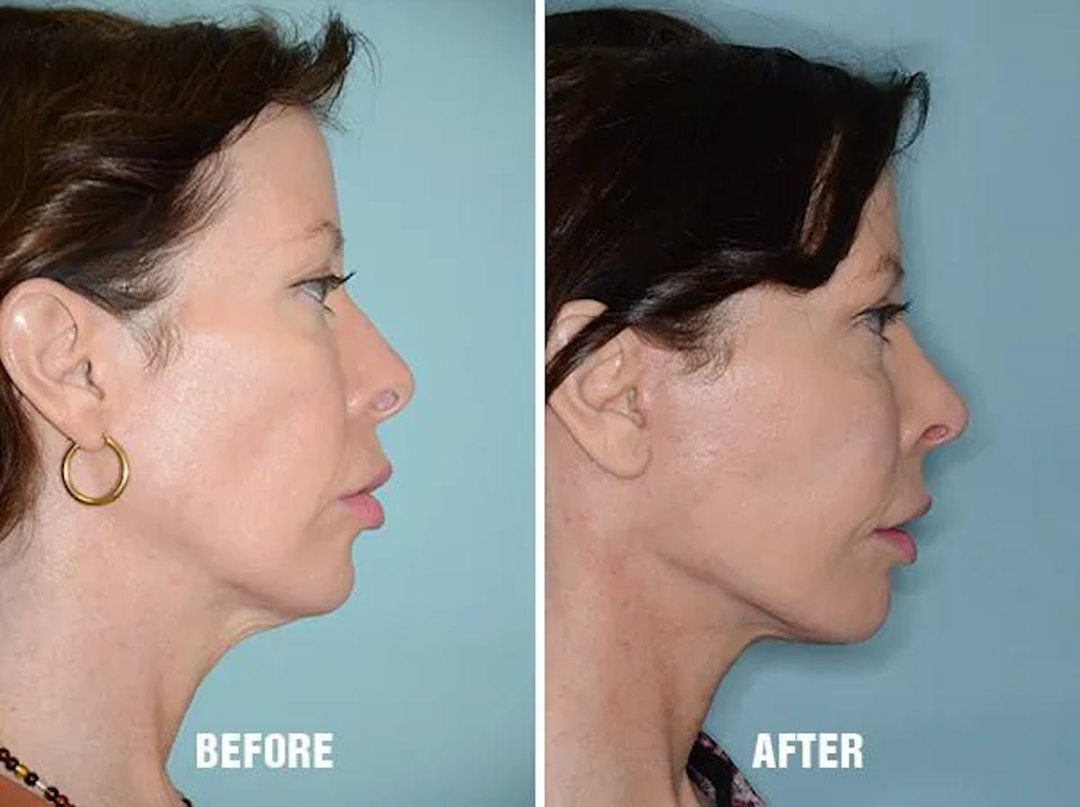 Chin Augmentation before and after, lateral right.