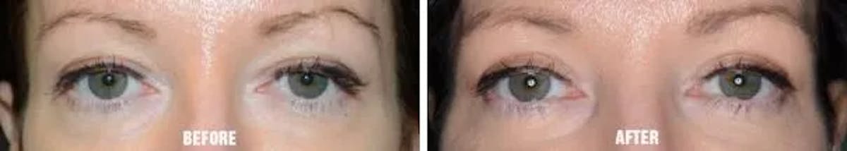 Chin Augmentation before and after, frontal.
