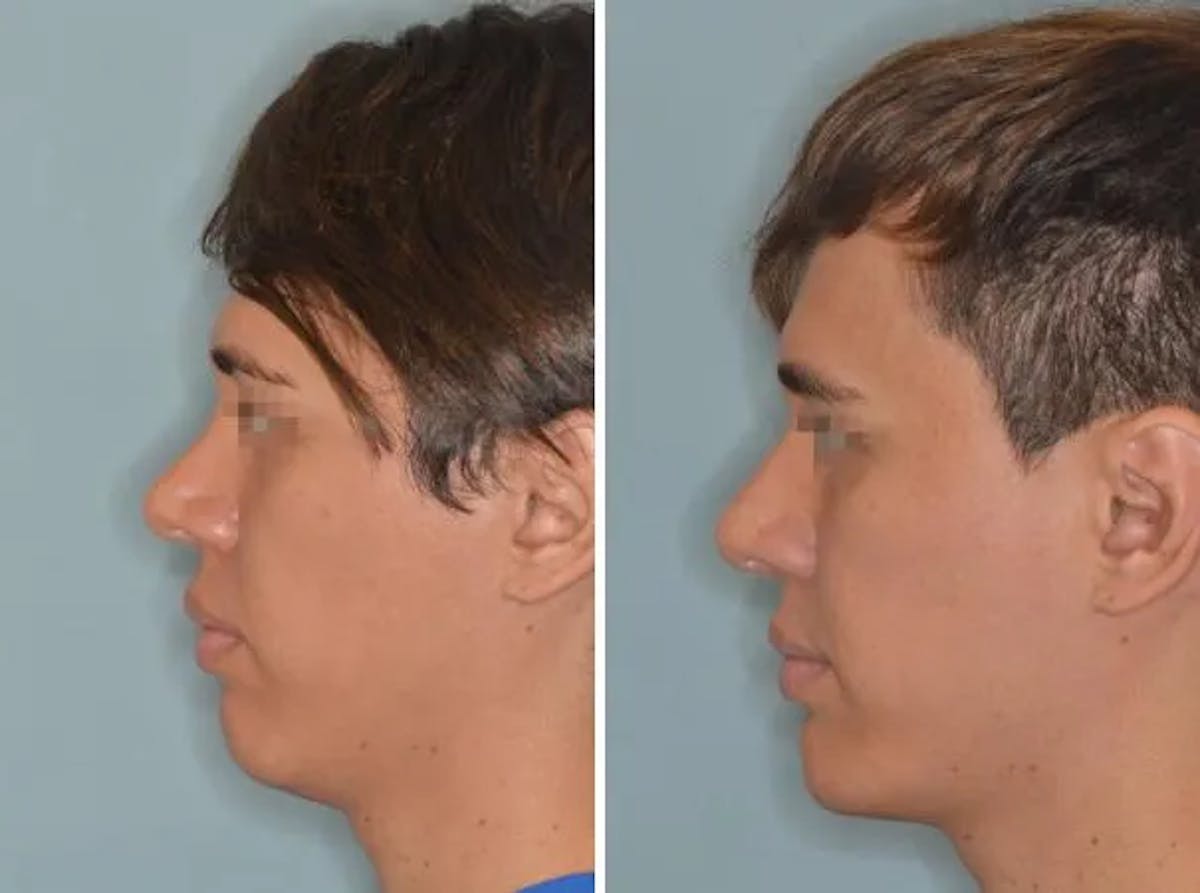 Chin Augmentation before and after, lateral left.