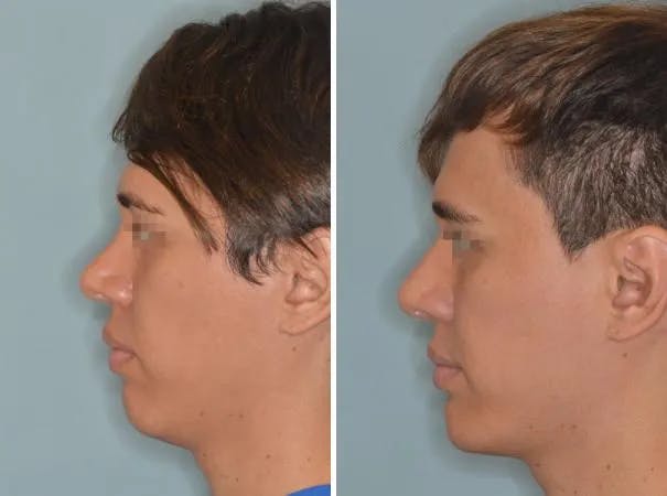 Chin Augmentation before and after, lateral left.