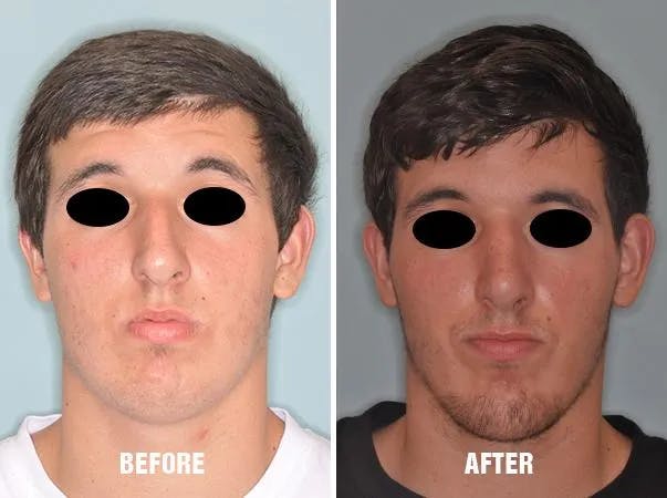 Chin Augmentation before and after, frontal.