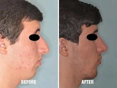 Chin Augmentation before and after, lateral right.
