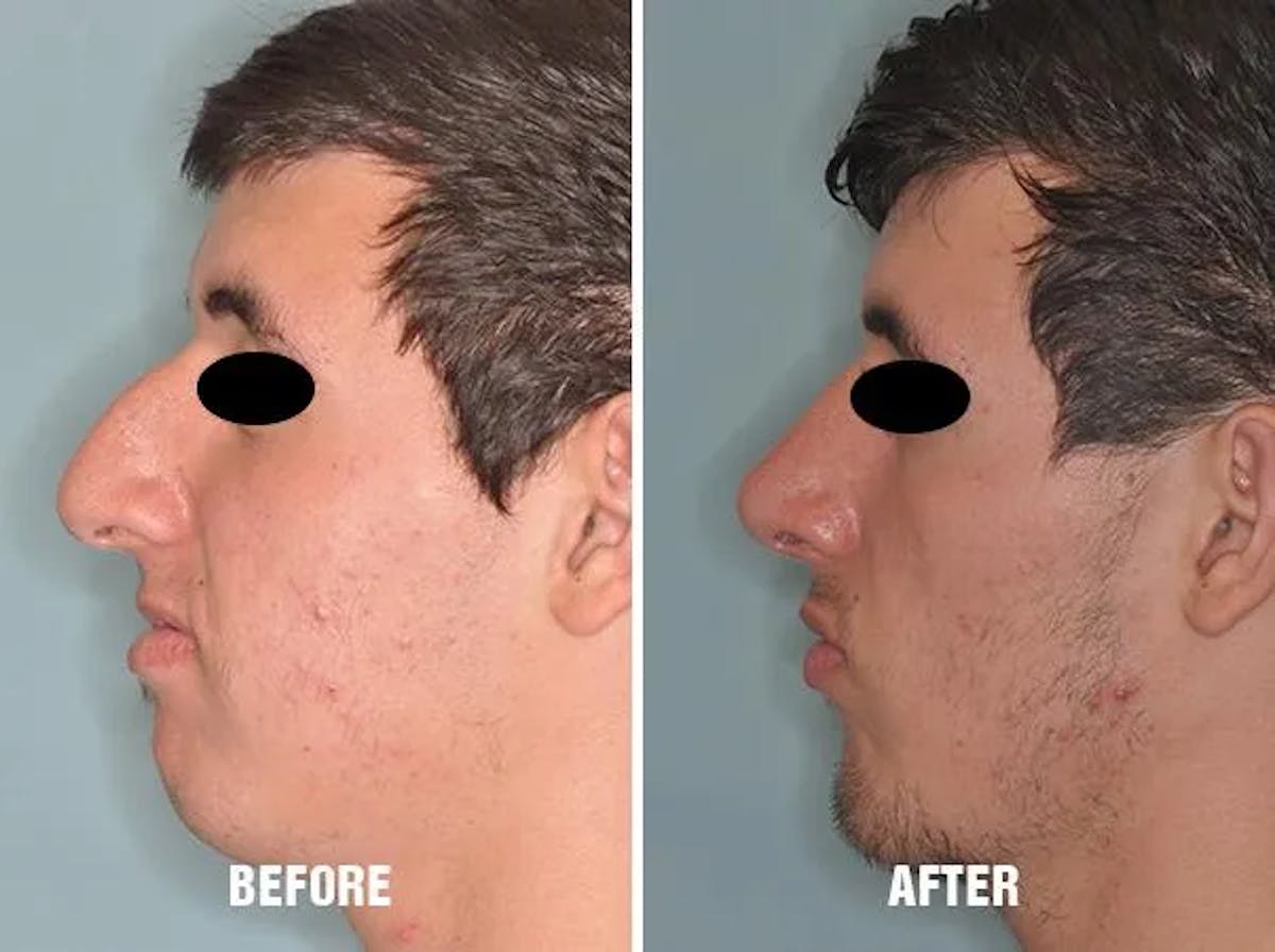 Chin Augmentation before and after, lateral left.