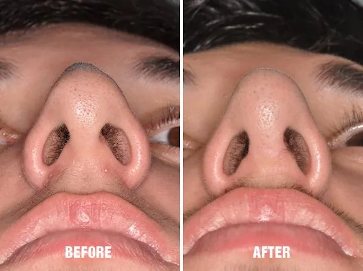 Chin Augmentation before and after, frontal.
