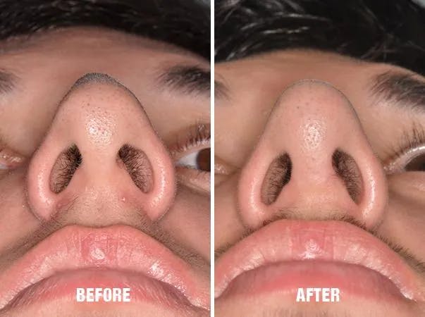 Chin Augmentation before and after, frontal.