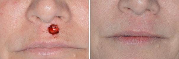 Facial Reconstruction before and after, frontal.