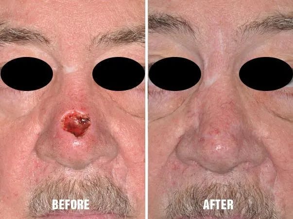 Facial Reconstruction before and after, frontal.