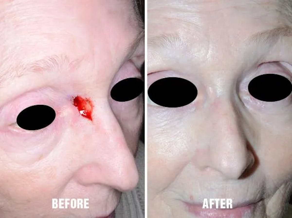 Facial Reconstruction before and after, oblique right.