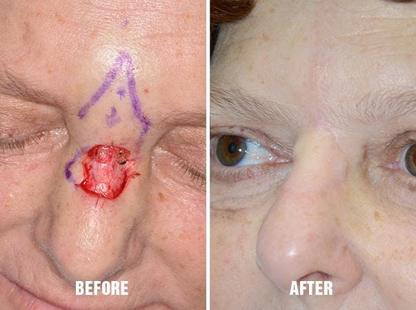 Facial Reconstruction before and after, marked.