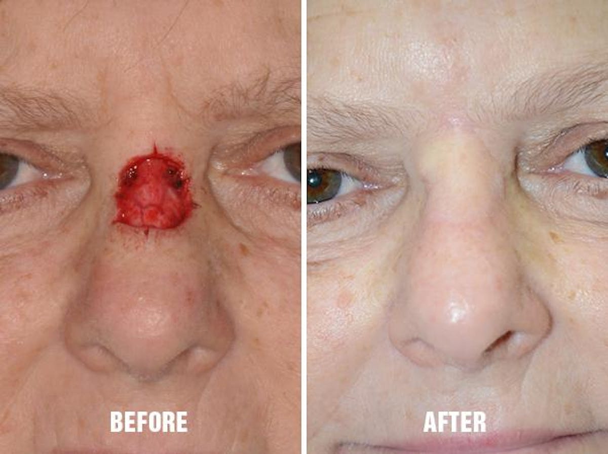 Facial Reconstruction before and after, frontal.