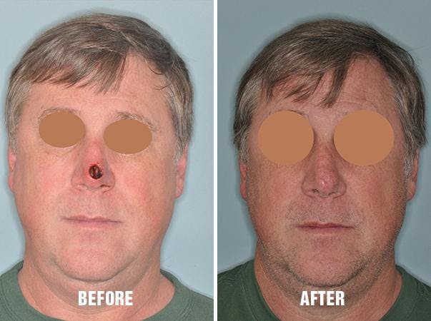 Facial Reconstruction before and after, frontal.