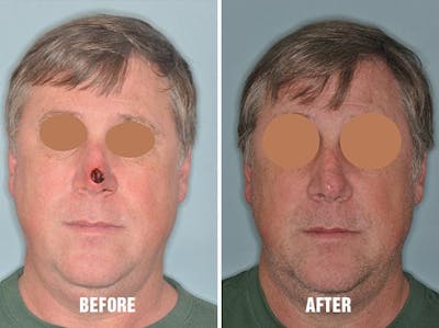 Facial Reconstruction before and after, frontal.