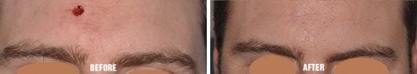 Facial Reconstruction before and after, frontal.