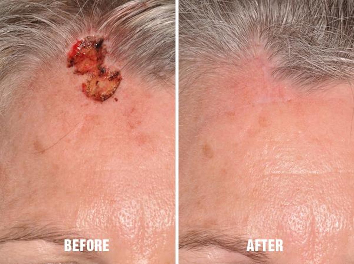 Facial Reconstruction before and after, frontal.