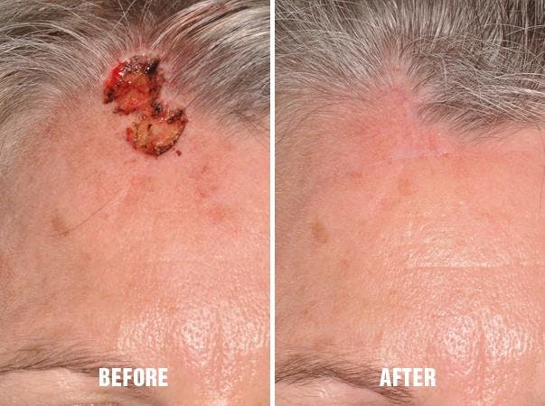 Facial Reconstruction before and after, frontal.