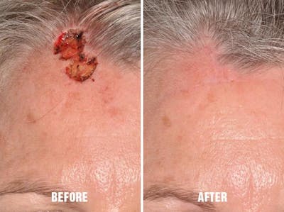 Facial Reconstruction before and after, frontal.