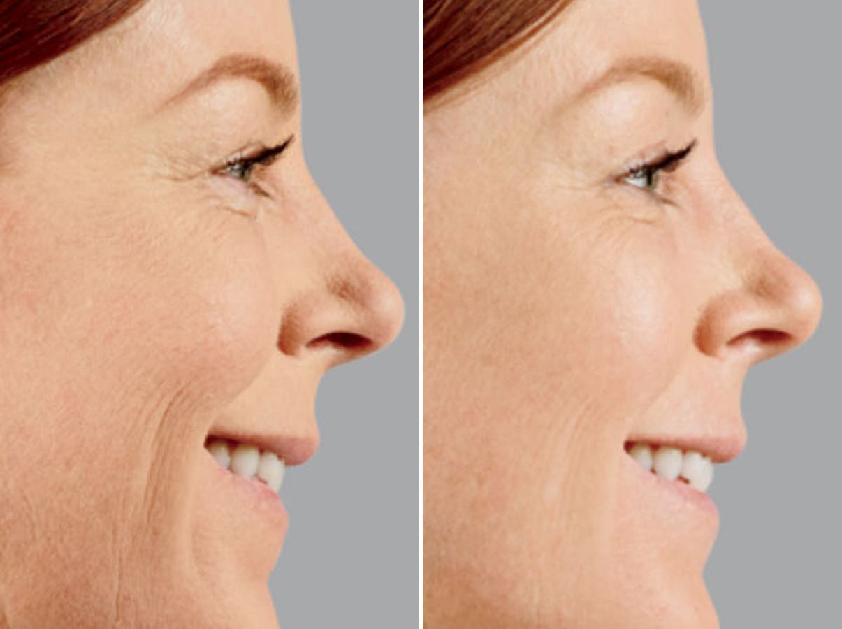 Voluma before and after, lateral right.
