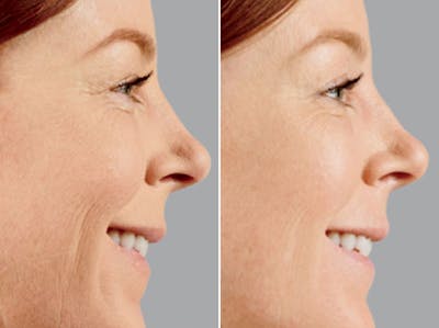 Voluma before and after, lateral right.