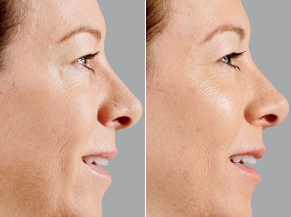 Voluma before and after, lateral right.