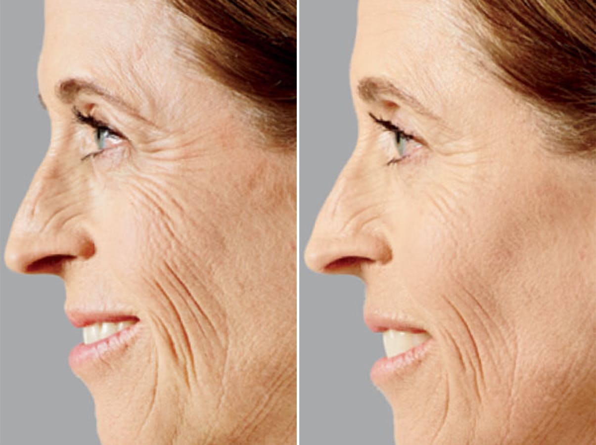 Voluma before and after, lateral left.