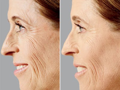 Voluma before and after, lateral left.