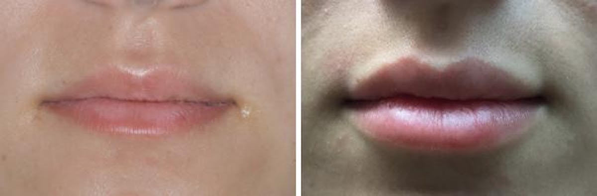 Injectables before and after, frontal.