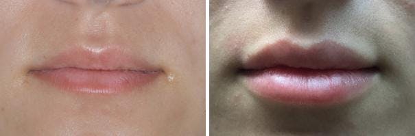Injectables before and after, frontal.