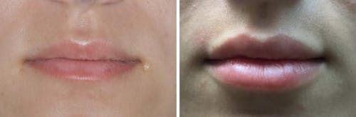 Injectables before and after, frontal.