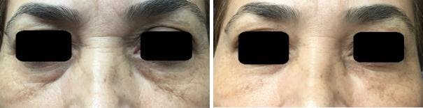 Injectables before and after, frontal.