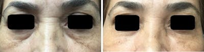 Injectables before and after, frontal.