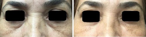Injectables before and after, frontal.