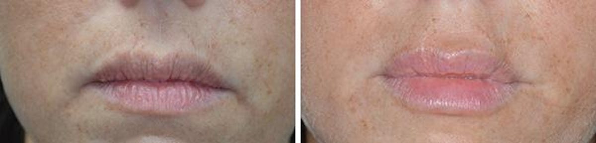 Injectables before and after, frontal.