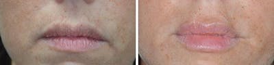 Injectables before and after, frontal.