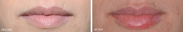 Injectables before and after, frontal.