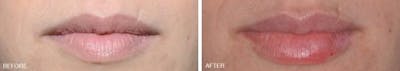 Injectables before and after, frontal.
