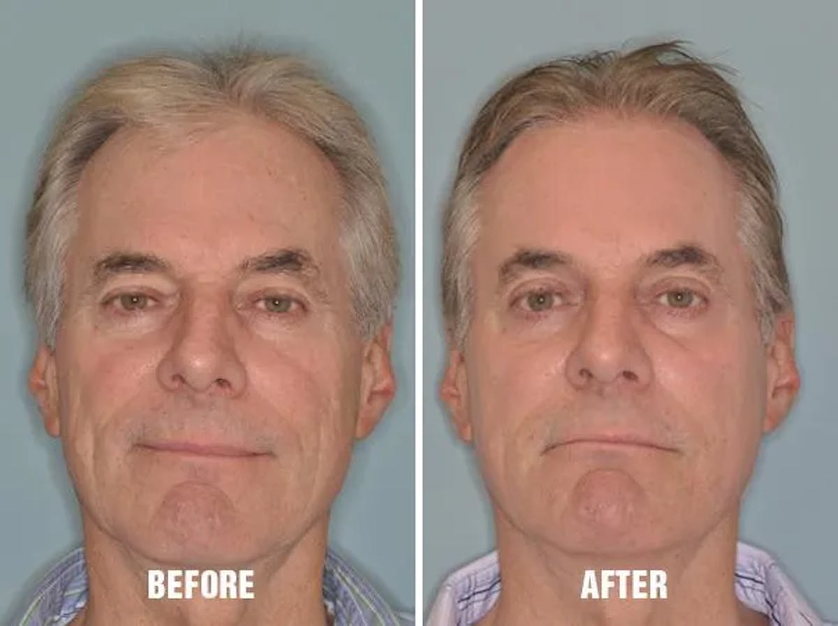 Injectables before and after, frontal.