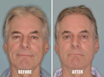 Injectables before and after, frontal.