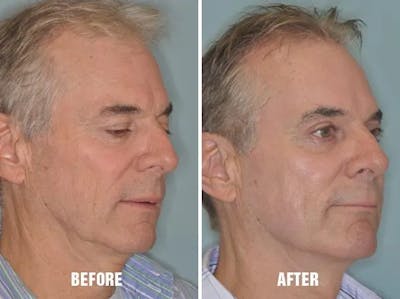Injectables before and after, oblique right.