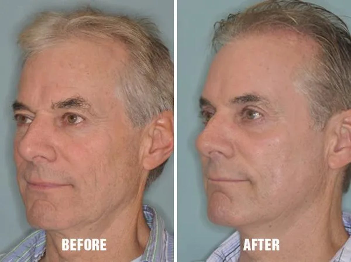 Injectables before and after, oblique left.