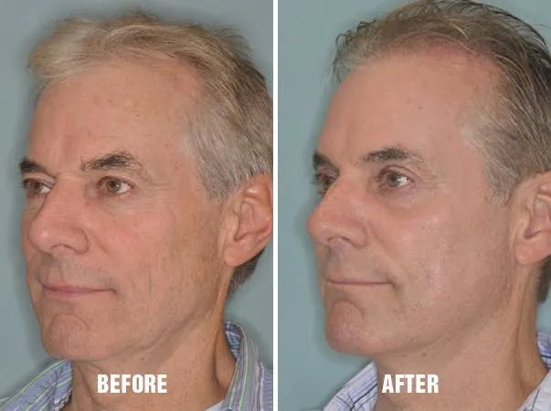 Injectables before and after, oblique left.
