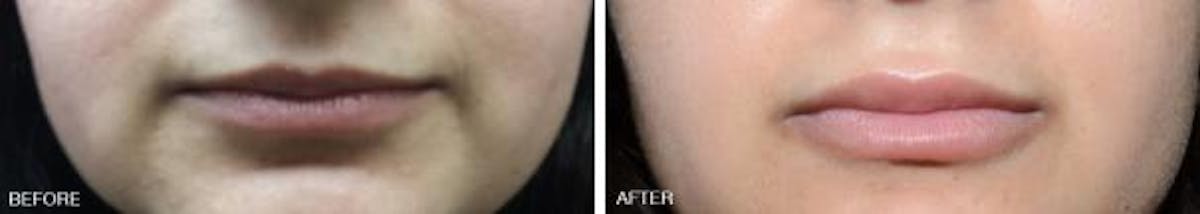 Injectables before and after, frontal.