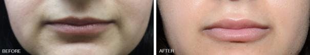 Injectables before and after, frontal.